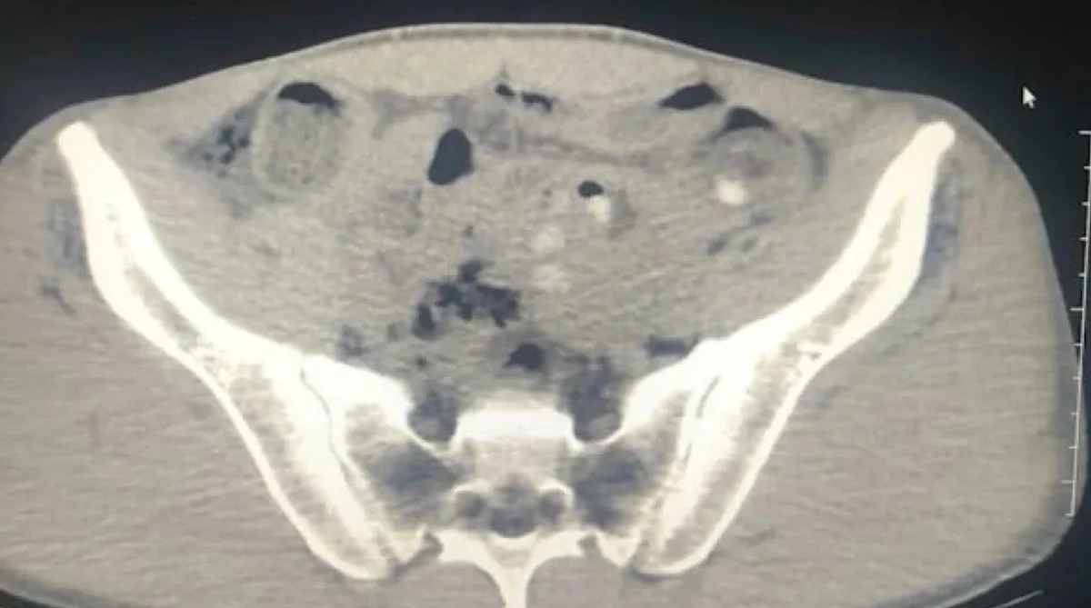 3 Kişi Midelerinde Uyuşturucu İle yakalandı
