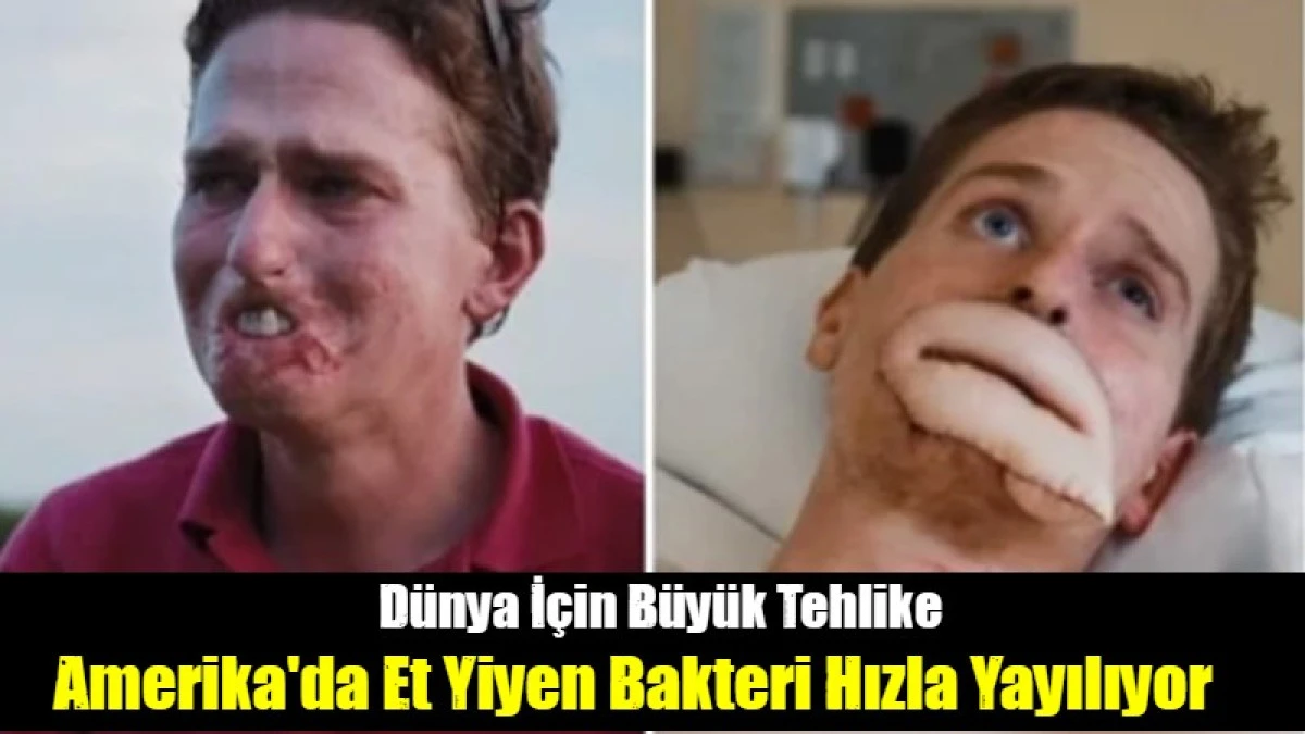Et Obur Bakteri Hızla Yayılıyor