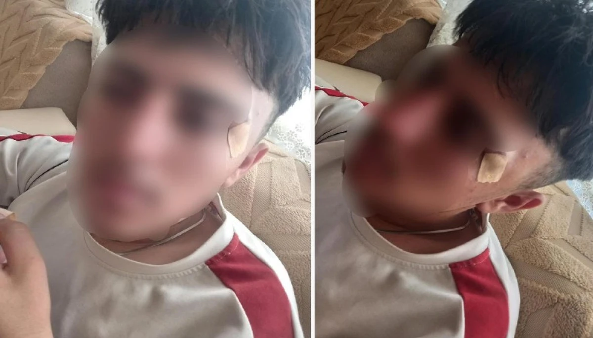 &Ouml;ğretmenin Kafa Attığı &Ccedil;ocuğun Burnu Kırıldı